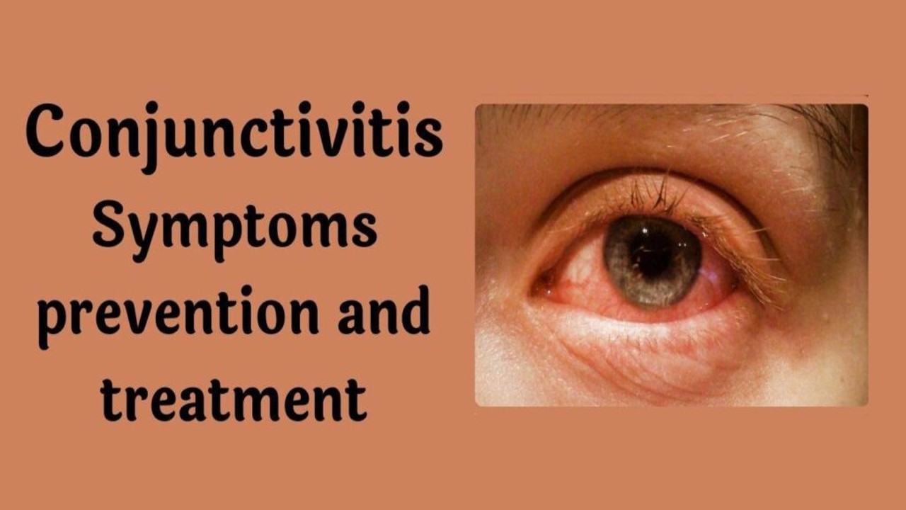 Pink Eye Conjunctivitis Causes Treatment And Prevention
